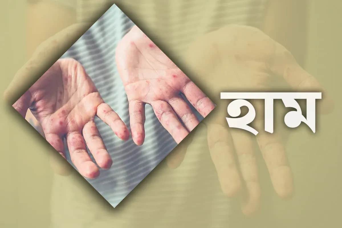 হামে একদিনে আরও ৭ মৃত্যু, সন্দেহজনক রোগী ৮৫৫