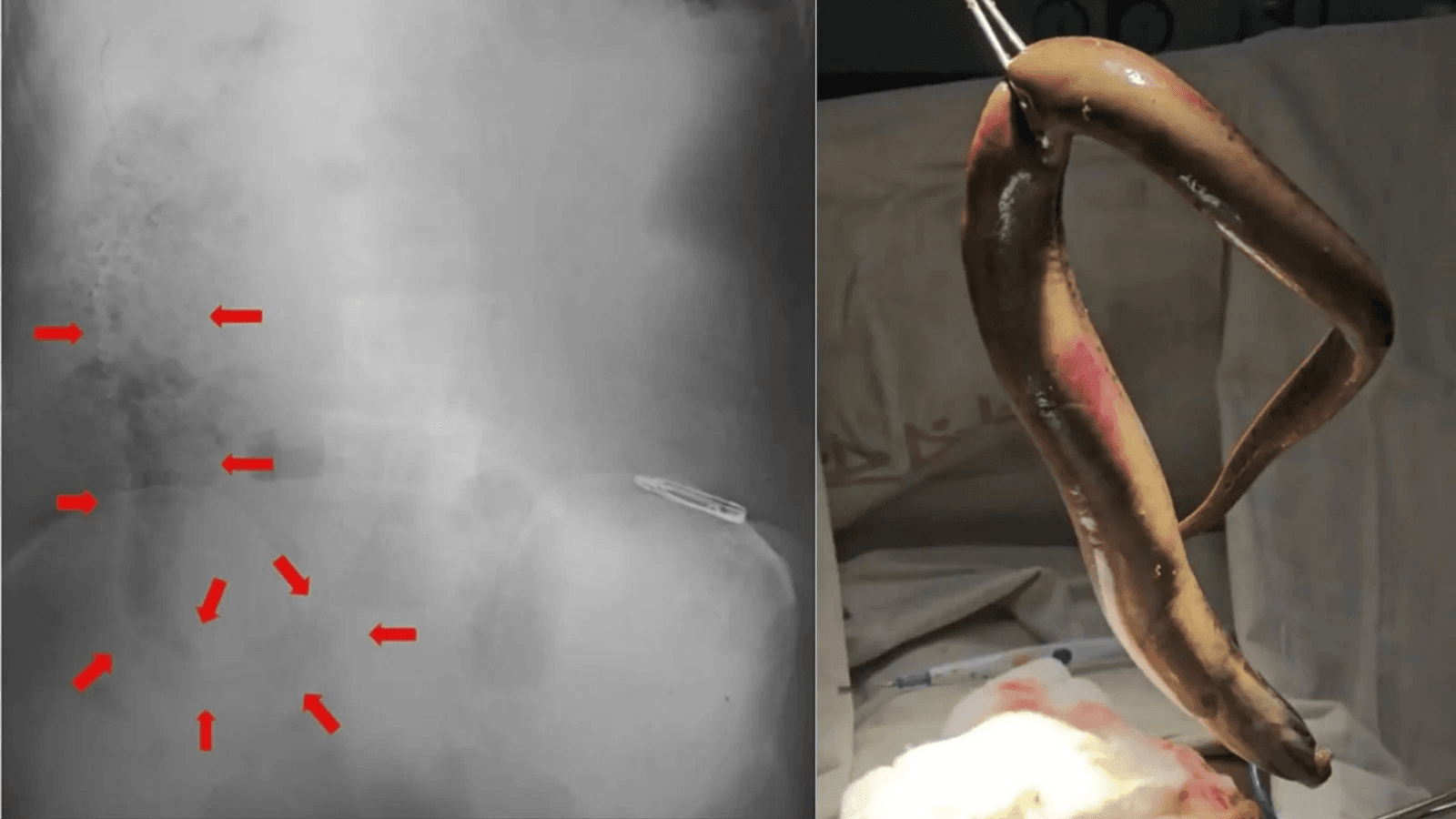 পায়ুপথ দিয়ে জেলের পেটের ভেতর জীবন্ত বাইম মাছ, অপারেশনে বের করলেন চিকিৎসকেরা